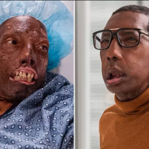 The Inspiring Journey of Robert Chelsea: The First African American Face Transplant Recipient