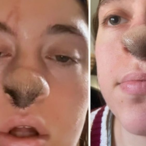 Dog Bite Leads To Hair Growing On Woman’s Nose: Photo Reveals Shocking Aftermath!