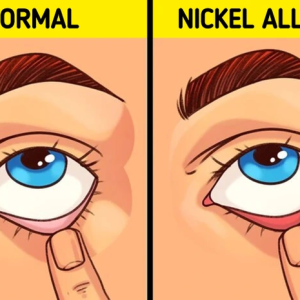 10 Warning Signs of a Nickel Allergy—Is Your Body Trying to Tell You Something