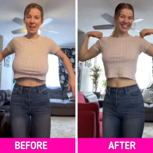 Woman Shares Her Breast Reduction Journey, Shocking the Internet with Stunning Results Woman Shares Her Breast Reduction Journey, Shocking the Internet with Stunning Results