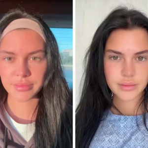 Young Woman Documents Her Fox Eye Surgery and Shocks People With the Results