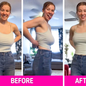 Woman’s Breast Reduction Journey Goes Viral: A Transformative Tale of Relief and Empowerment Woman’s Breast Reduction Journey Goes Viral: A Transformative Tale of Relief and Empowerment